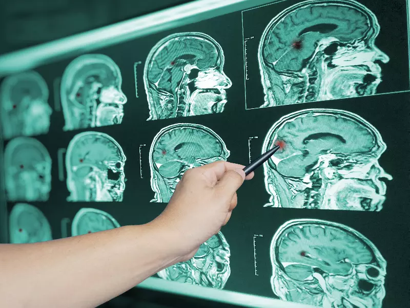 Concussion Treatment Near Me in Cary, NC. Chiropractor for Concussion Symptom Relief.